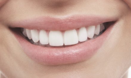 Qué son las carillas dentales? ¿Para qué sirven? ¿Cuáles son ventajas e  inconvenientes? - Clínica Dental Cervantes
