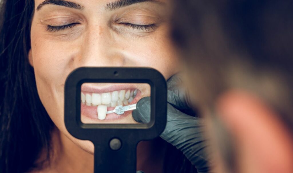 Foto de carillas dentales para ilustrar el post de cuánto duran las carillas dentales