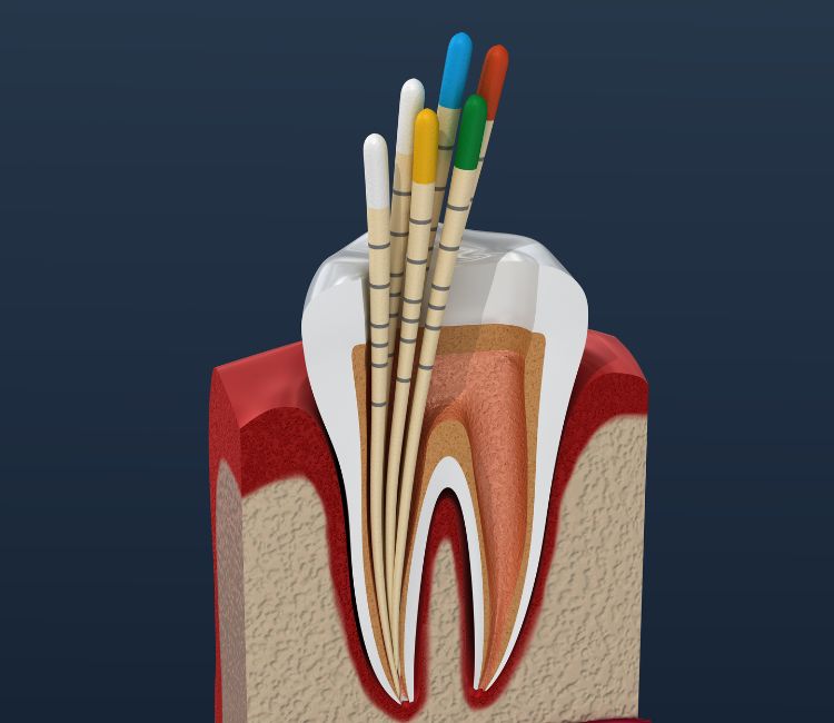 endodoncia en Alicante