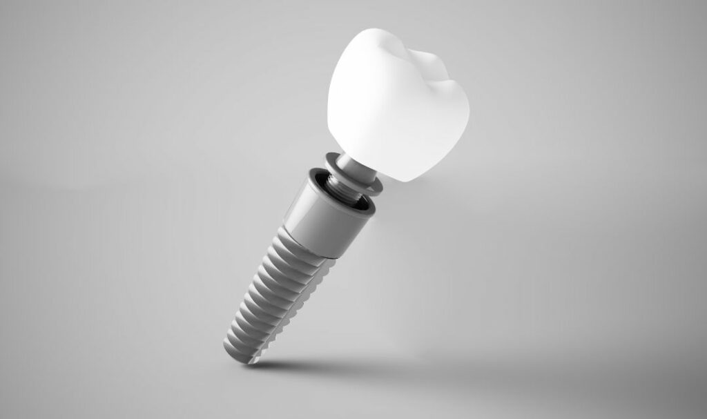 ¿Cuánto dura un implante dental