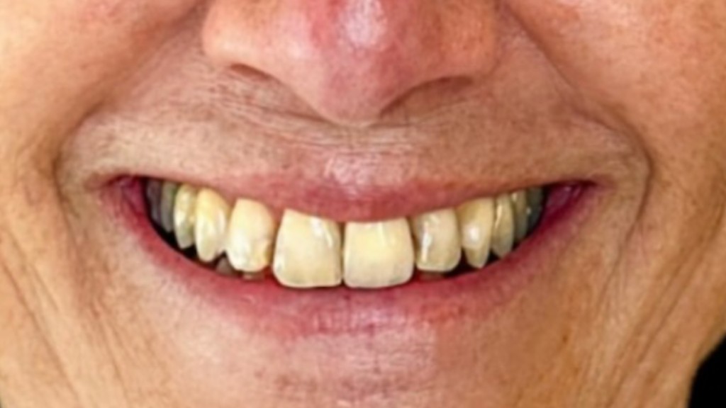 Antes