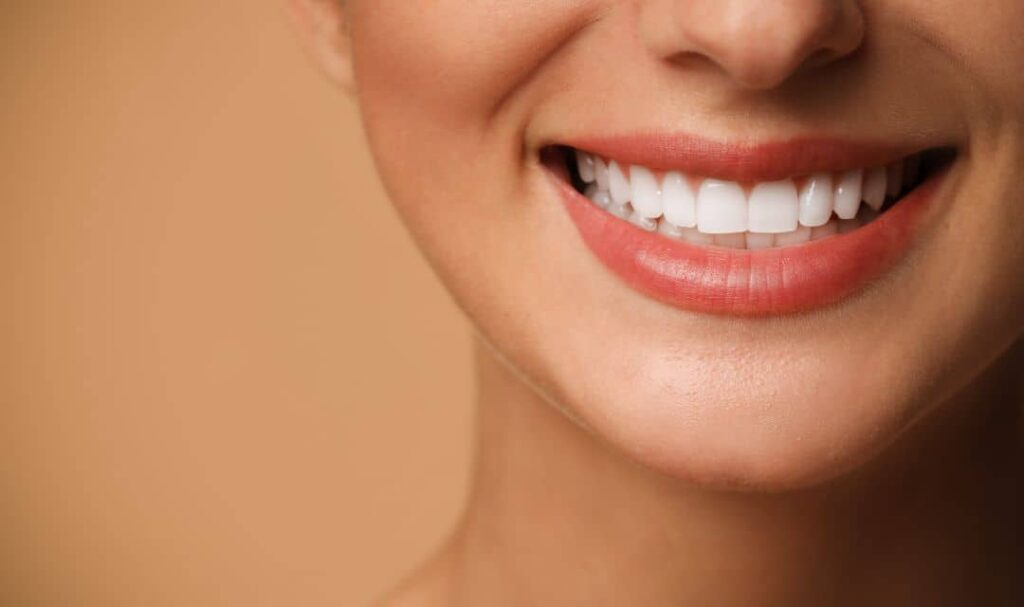Cuando se recomiendan las carillas dentales